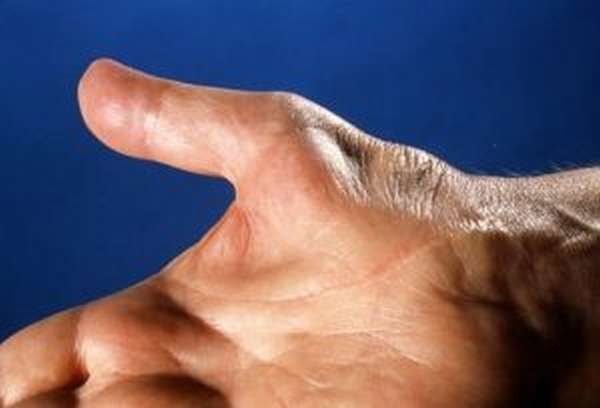 Эндопротезы суставов пальцев